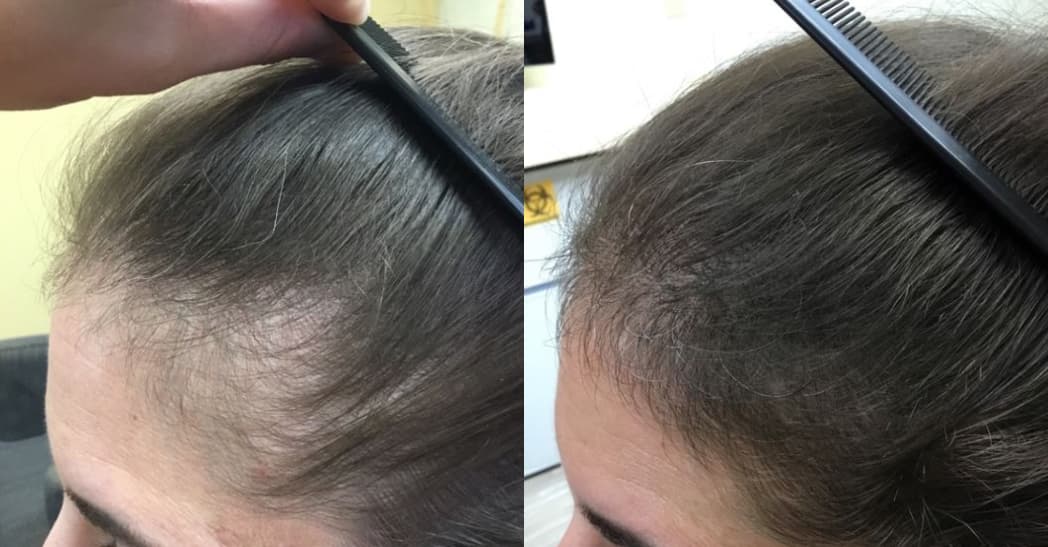 Platelet - Rich Plasma