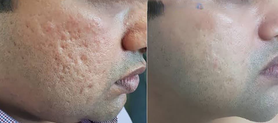 Dermatology treatment 6