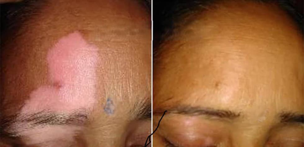 Dermatology treatment 7