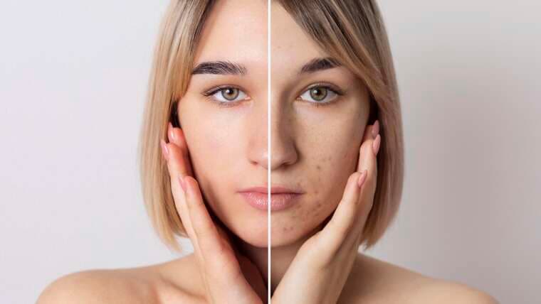 Scar Reduction 1