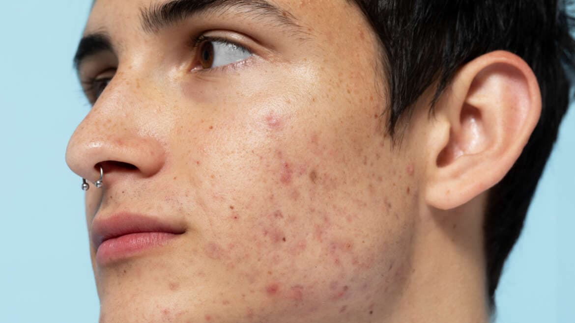 Laser treatment procedure for acne scars