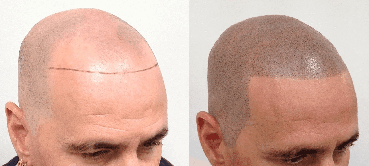 Scalp Micropigmentation
