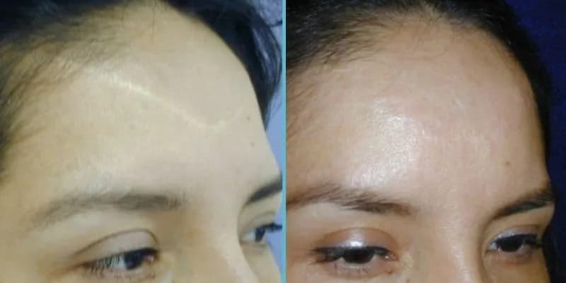 Scar Reduction