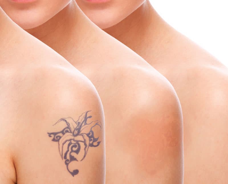 Laser Tattoo Removal